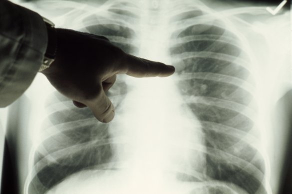 Doctor examining a patient's lungs. 